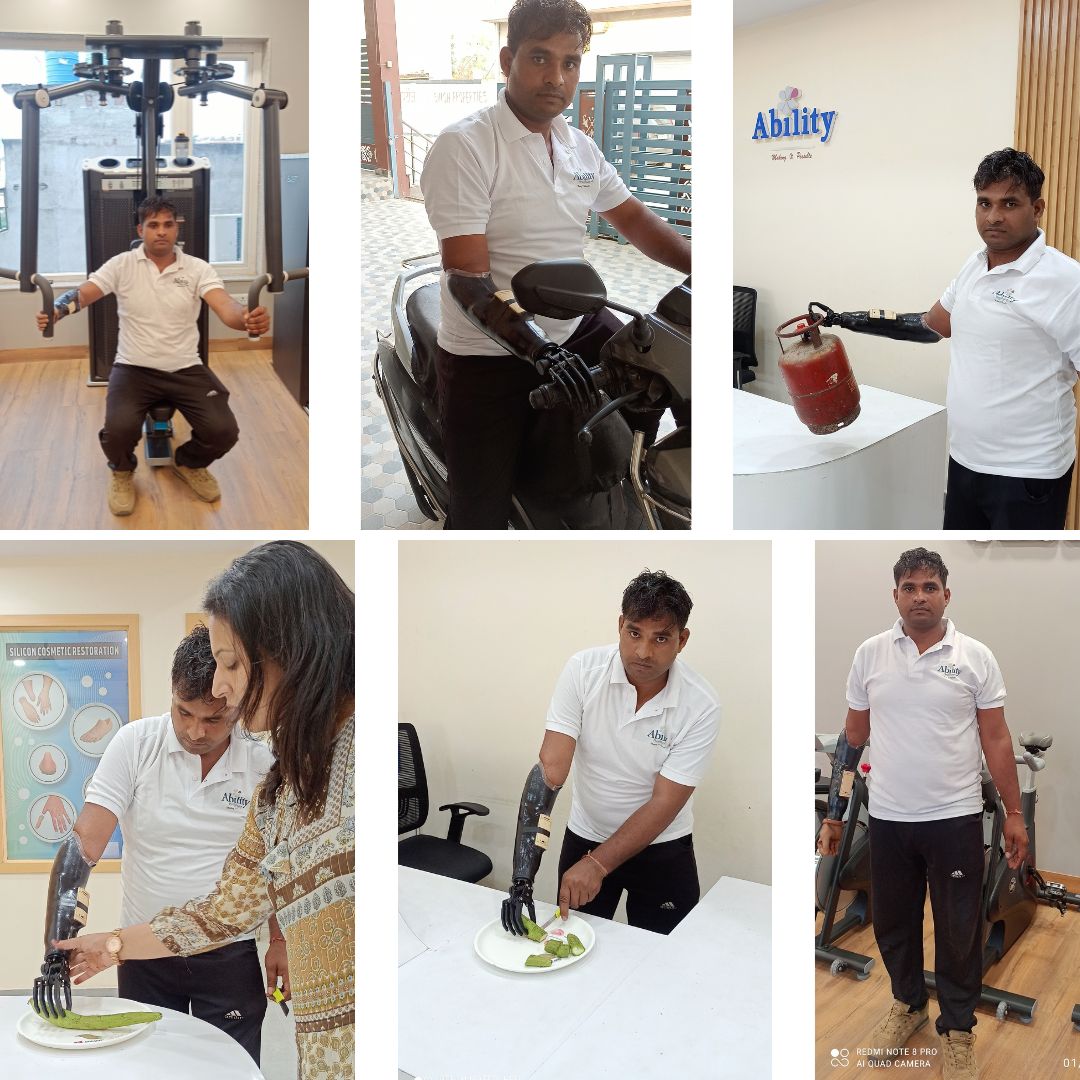 myoelectric hand in India